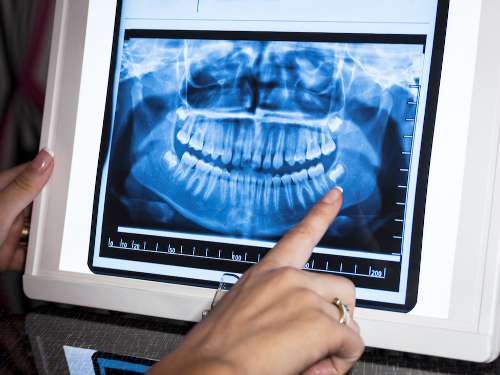 Digital X-Rays 